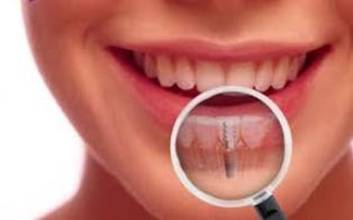 Cấy ghép răng Implant có đau không ?