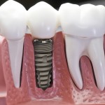 Cấy ghép Implant khi mất toàn bộ răng