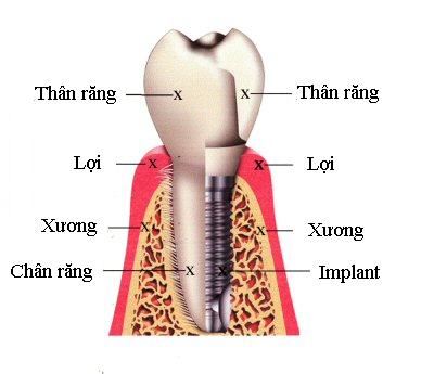Cấu tạo cấy ghép răng Implant