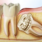 Răng khôn có nên nhổ không?