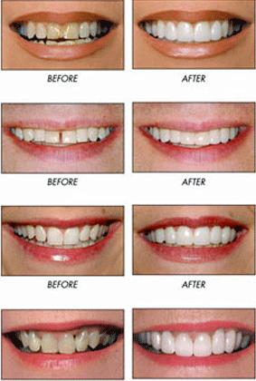 Trước và sau khi trám răng thẫm mỹ