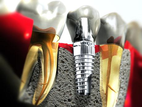 Cấy ghép răng Implant được thực hiện như thế nào ?