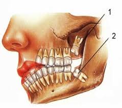 Răng khôn hàm trên thường mọc bất thường gây các bệnh nha nguy hiểm