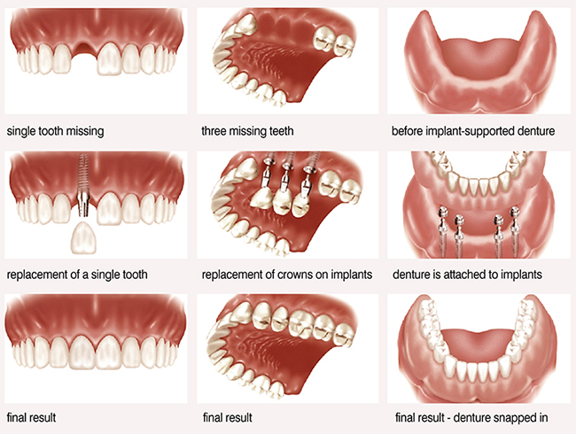 Phương pháp implant mini