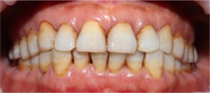 Nguyên nhân răng sậm màu và cách điều trị