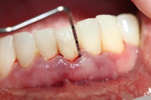 Nguyên nhân và cách điều trị viêm nướu răng