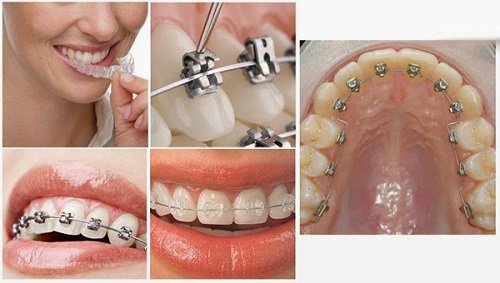 Lựa chọn nha khoa niềng răng nào tốt