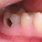 Nhổ hay bảo tồn răng sâu