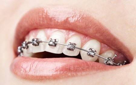 Thời gian điều trị niềng răng thẩm mỹ