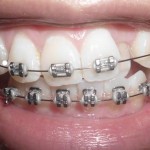 Thời gian và chi phí cho điều chỉnh răng hô