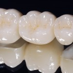 Ưu điểm của răng sứ E.Max là gì tại nha khoa ngày nay?