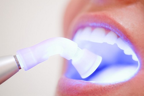 Tẩy trắng răng là gì ?