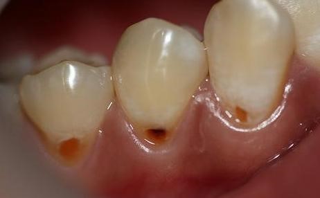 Sâu răng có nguy hiểm không ?