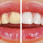 Phương pháp tẩy trắng răng trong y khoa