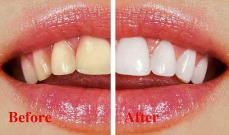 Phương pháp tẩy trắng răng trong y khoa