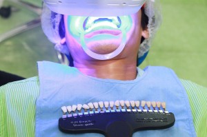 Tẩy trắng răng bằng Laser Whitening