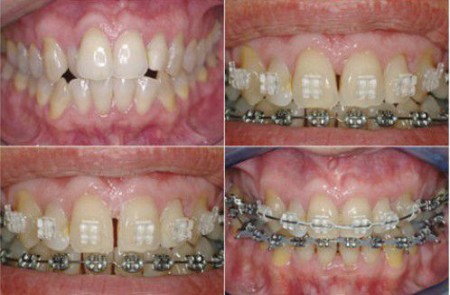 Niềng răng tại nha khoa Đăng Lưu giúp bạn sở hữu một hàm răng chắc khỏe đều đẹp.