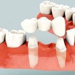 Cách tính chi phí cho phục hồi răng toàn hàm