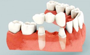 Cách tính chi phí cho phục hồi răng toàn hàm