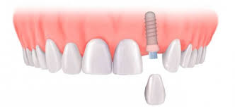 Phương pháp cấy ghép implant là gì?