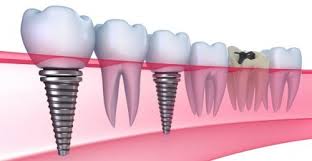 Chi phí cho việc cấy ghép răng implant là bao nhiêu?