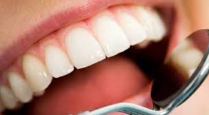 Điều trị đúng chuẩn nha khoa để khắc phục vấn đề đen chân răng