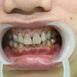 Tẩy trắng răng bị nhiễm tetra như thế nào hiệu quả?