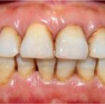 Khắc phục răng nhiễm tetracycline