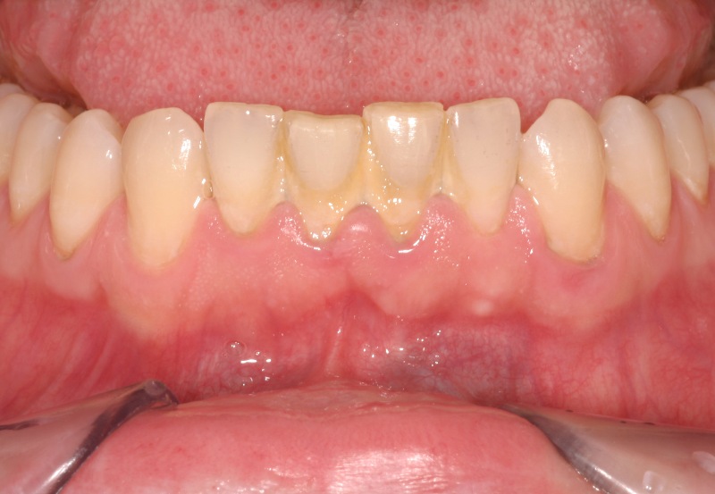 Phương pháp lấy cao răng siêu âm