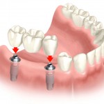 Những đối tượng không nên cấy ghép răng implant