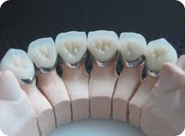 Bọc răng sứ Titan chất lượng