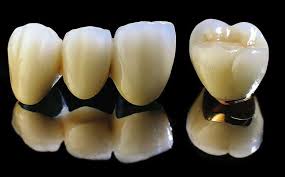 Phục hình răng sứ Titan