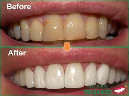 Hình ảnh trước và sau tẩy trắng răng bằng công nghệ BleachBright