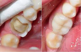 Vật liệu nào có thể dùng trám răng