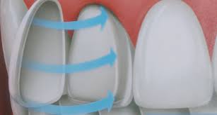 Bọc răng sứ phục hình răng bị sứt mẻ