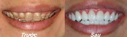 Hình ảnh trước và sau khi bọc răng sứ răng nhiễm Tetracycline