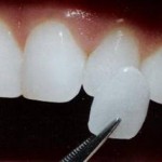 Khái quát về bọc sứ răng