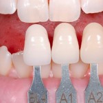 Phương pháp trồng răng thẩm mỹ
