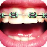 Các phương pháp niềng răng hô hàm trên