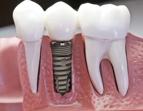 Cấy ghép răng Implant được thực hiện như thế nào ?