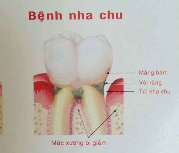 Chảy máu chân răng có thể do bệnh nha chu
