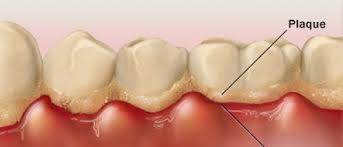 Mảng bám trên răng là nguyên nhân gây viêm nướu