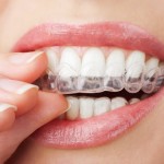 Dịch vụ tẩy trắng răng có an toàn không ?