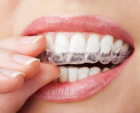 Dịch vụ tẩy trắng răng có an toàn không ?