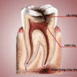 Điều trị răng chết tủy