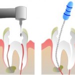 Điều trị tủy răng có đau không ?
