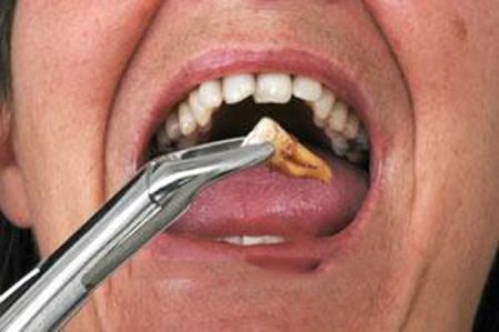 Khi răng bị đau nên làm gì?