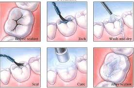 Quy trình trám răng cho răng sâu