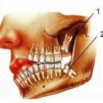 Nhổ răng có giảm trí nhớ không?