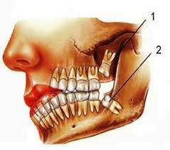 Nhổ răng có giảm trí nhớ không ?